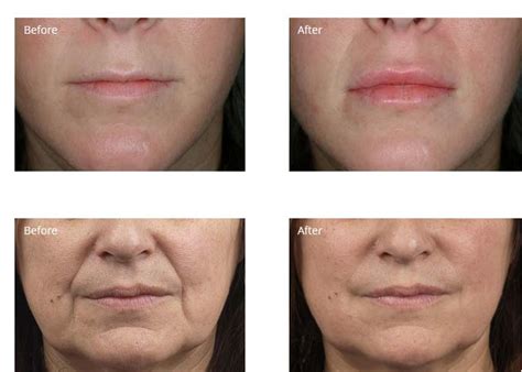 what dermal fillers are similar to one another